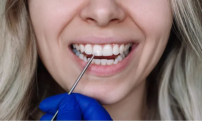 כתמים על השיניים - סוגים, גורמים, טיפול ומניעה